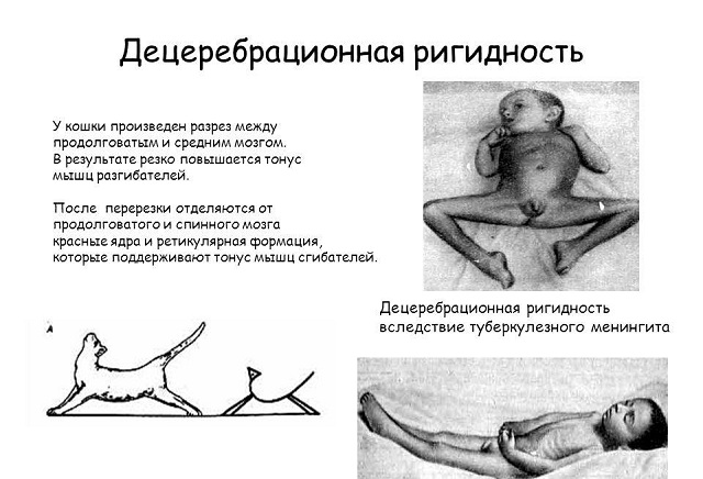 поражение ствола мозга и симптомы